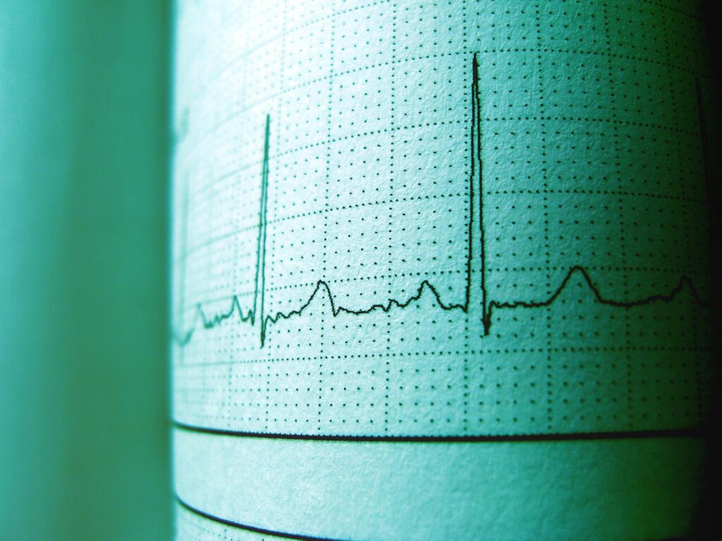 EKG